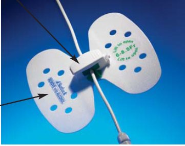 STAT LOK SM STABILIZATION DEVICE 6-8 FR EACH, (25/CASE) STAT LOK SM STABILIZATION DEVICE 6-8 FR EACH, (25/CASE)